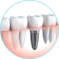 capa-impla-dental